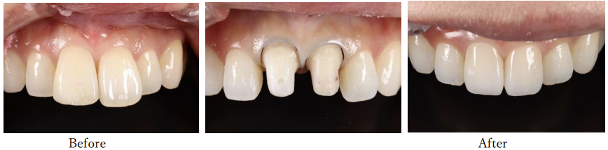 前歯部審美治療（ジルコニア）beforeafter