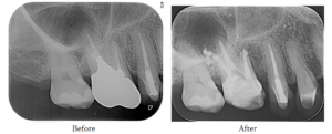 精密根管治療beforeafterレントゲン①