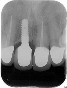 インプラント埋入後のレントゲン