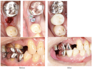 インプラント症例写真