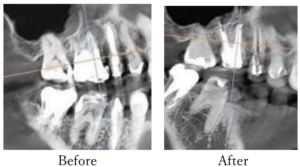 精密根管治療beforeafterレントゲン②