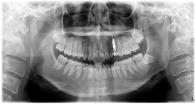 インプラント埋入後のレントゲン