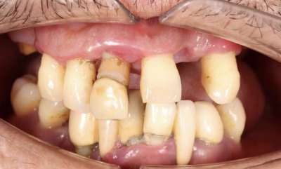 インプラント症例before