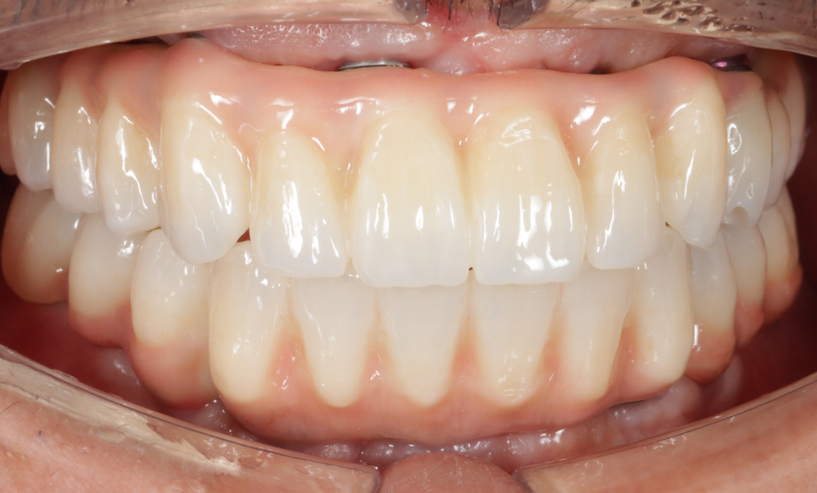 インプラント症例after