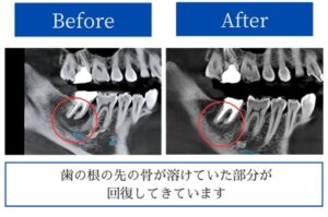 根管治療のBeforeAfterのレントゲン