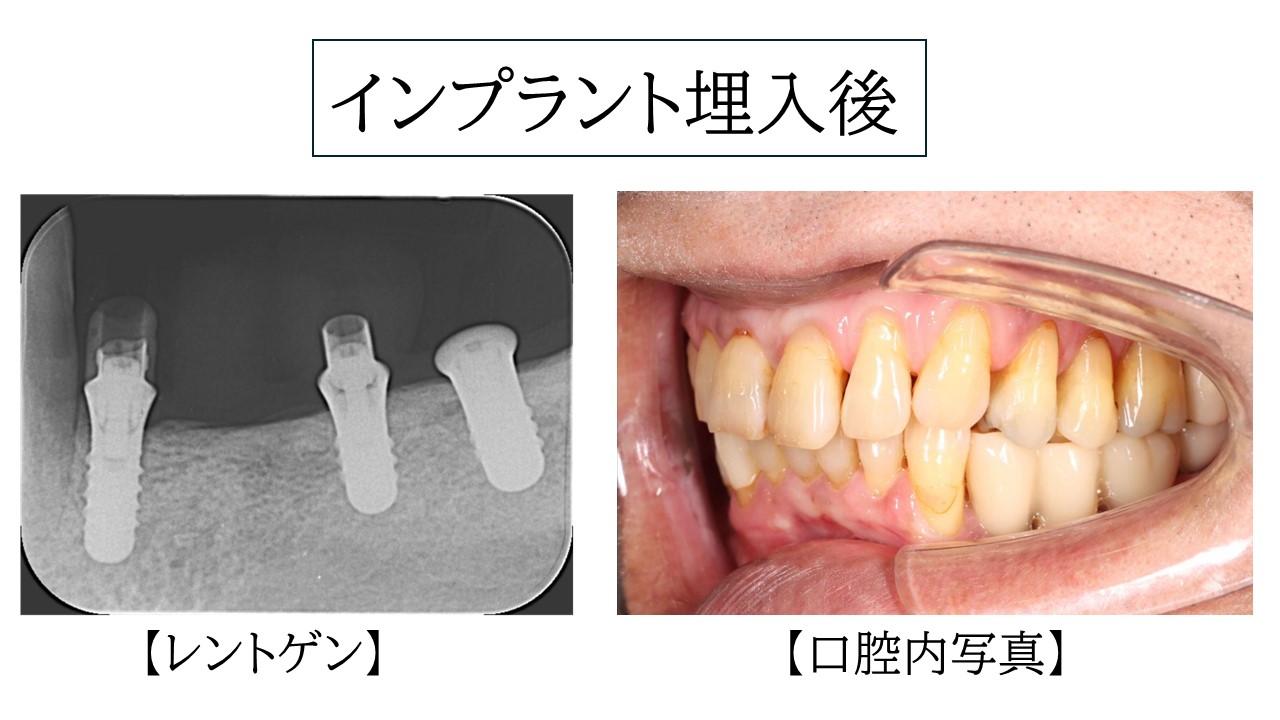 インプラント埋入後のレントゲン写真と口腔内写真