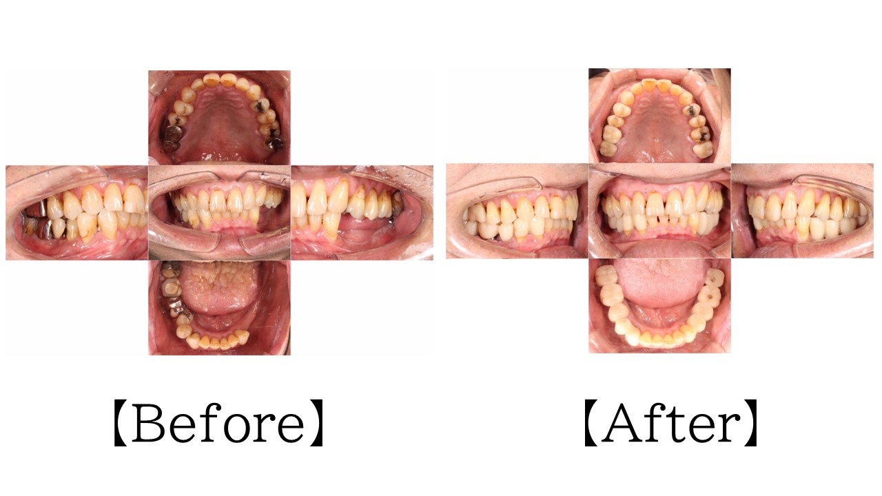インプラント埋入後の全体の口腔内写真