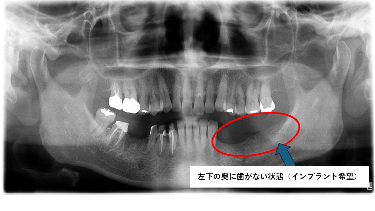 失った歯のレントゲン写真