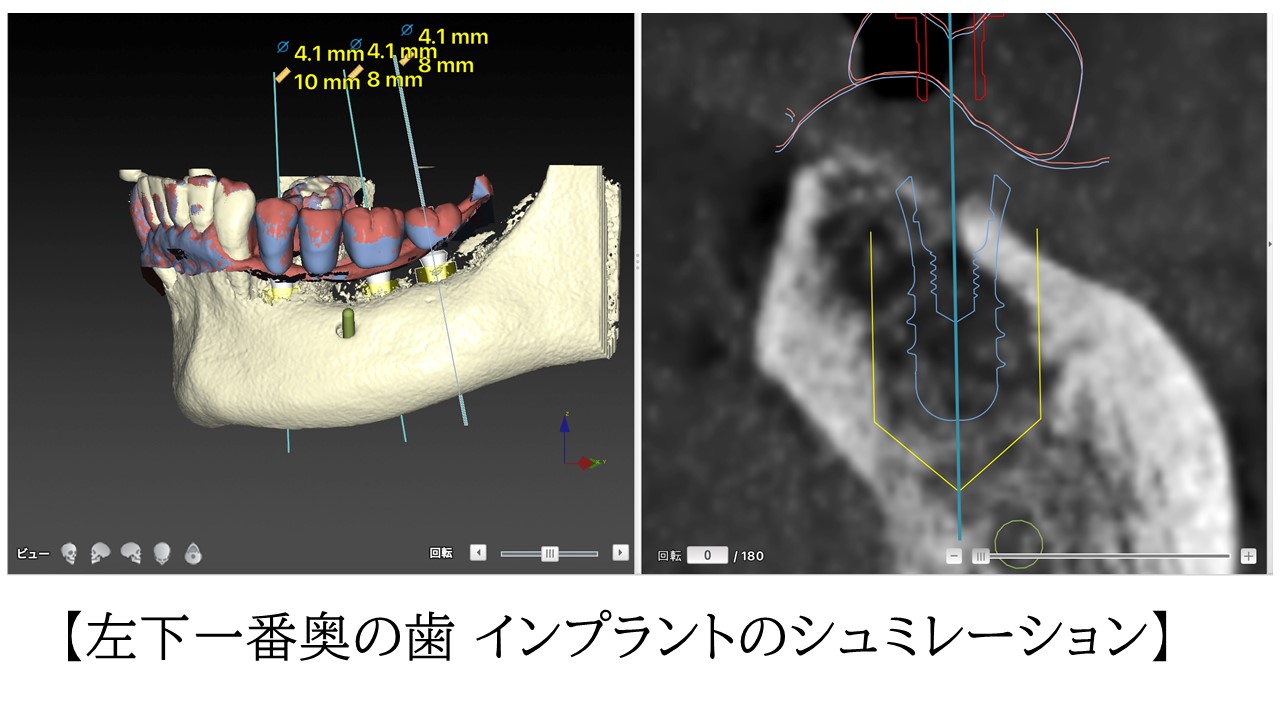 左下一番奥の歯インプラントのシミュレーション