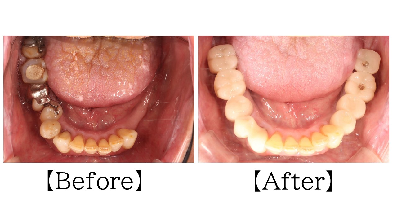 インプラント治療のbeforeafterの写真