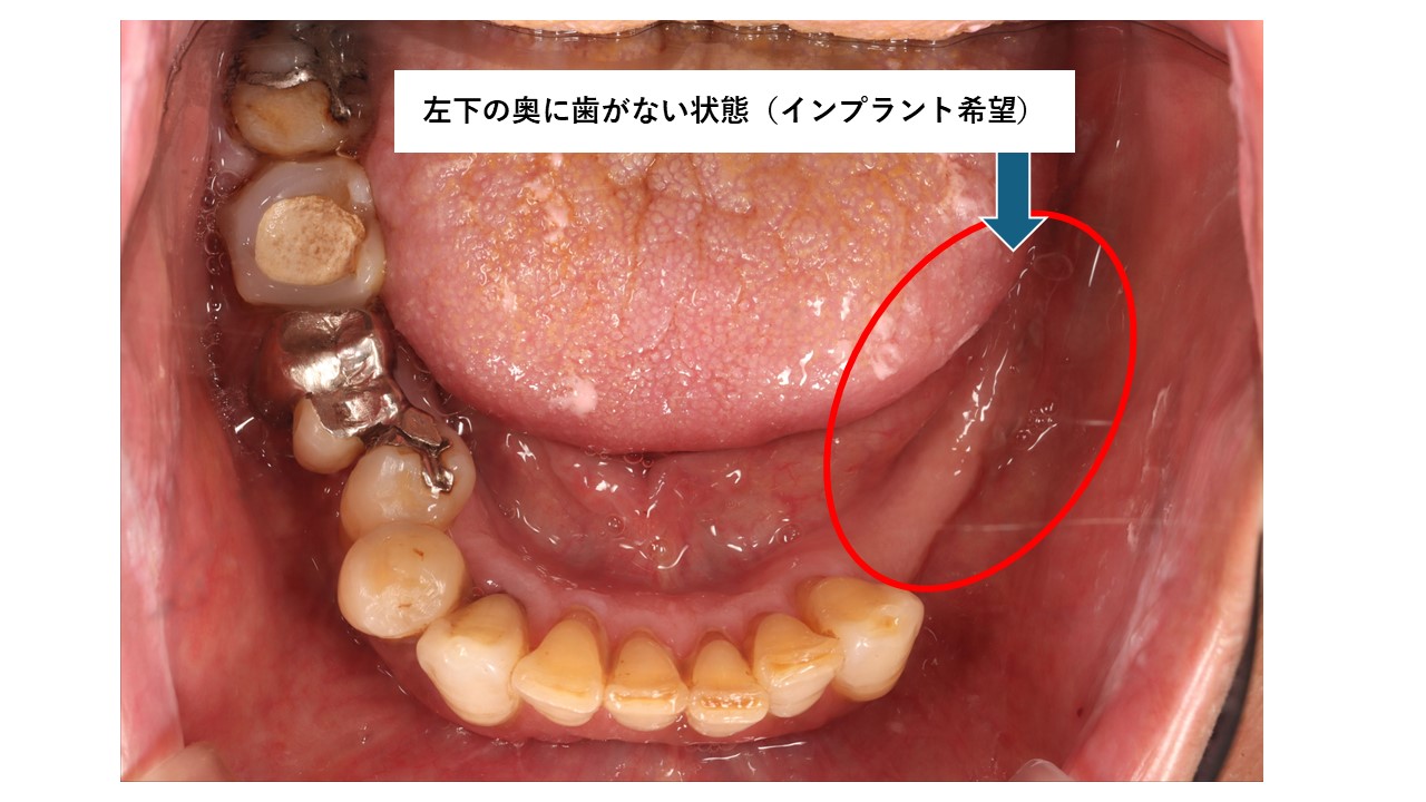 失った歯の口腔内写真