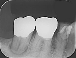 歯のレントゲン