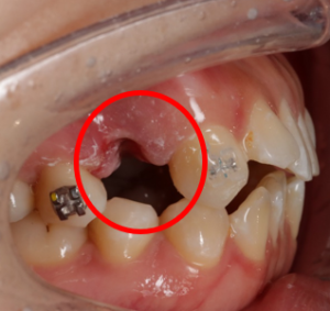 抜歯後の歯
