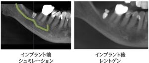 インプラントのシミュレーションレントゲン