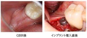 インプラント埋入の症例画像