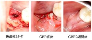 GBRの経過