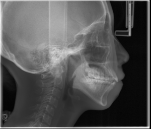 矯正前のレントゲン（横顔）
