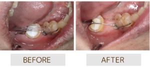 アップライト治療のBeforeAfter