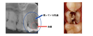 残っている乳歯と虫歯の症例画像