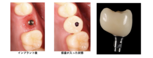 インプラント治療の経過画像