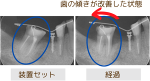 傾いている歯のレントゲン