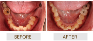 アップライト治療のBeforeAfter