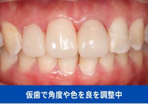 仮歯で角度や色を良を調整中