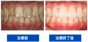 審美治療のBeforeAfter
