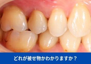 どれが被せ物かわかりますか？