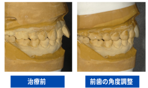 仮歯（プロビジョナルレストレーション）を装着症例画像