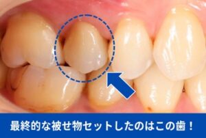 最終的な被せ物セットしたのはこの歯！