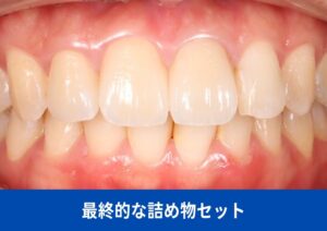 最終的な詰め物をセット