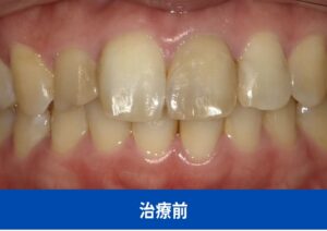 審美治療の治療前症例画像