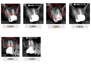 サイナストラクトの症例レントゲン画像