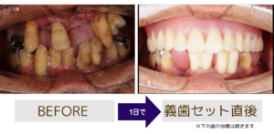 抜歯即時デンチャーBeforeAfter画像