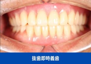 抜歯即時義歯症例After画像