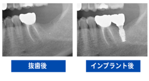 インプラント症例のBeforeAfterレントゲン画像