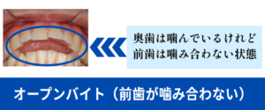 初診時症例画像の詳細(オープンバイト)