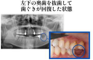 治癒期間を経た画像