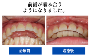 前歯が噛み合うようになった
