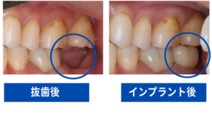 インプラント症例のBeforeAfter画像