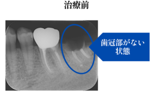 インプラント治療前のレントゲン画像