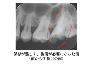 保存が難しく抜歯が必要になった歯のレントゲン