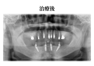 オールオン4治療後症例レントゲン