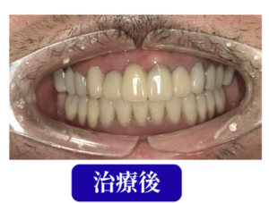 オールオン4治療後症例画像