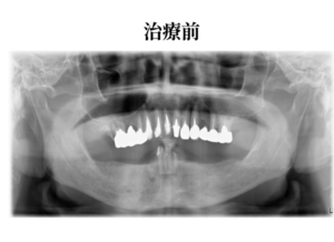 オールオン4治療前症例レントゲン