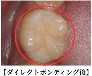 ダイレクトボンディング治療後の画像