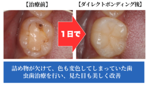 ダイレクトボンディング治療BeforeAfter
