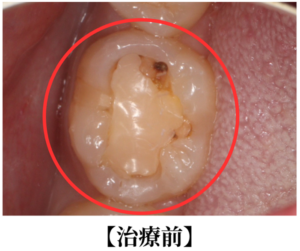 ダイレクトボンディング治療前の画像