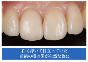 ラミネートベニア治療After症例画像